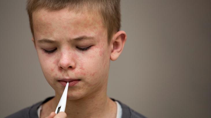 Avrupa’da kızamık vakaları 2024’te neredeyse on kat arttı